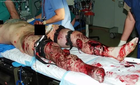 File:Blast injury-lower extremities.PNG - Wikimedia Commons