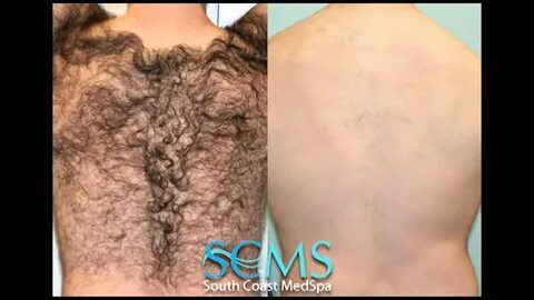 Laser Hair Removal of Back: Before/After - YouTube