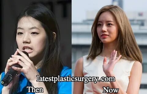 Hyeri double eyelid surgery before and after - Latest Plasti