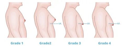 Gynaecomastia is the medical term for what is commonly known as Man boobs. 