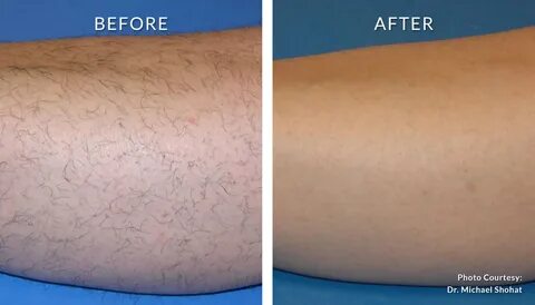 Brazilian Laser Hair Removal Before And After Pics - Amaze