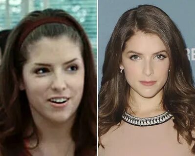 Anna Kendrick Plastic Surgery Rumors - The Truth Revealed!! 