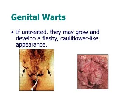 Genital Warts.