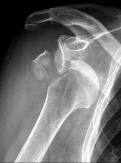 Proximal Humerus Fractures - Trauma - Orthobullets