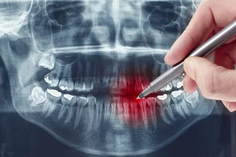 В каких случаях удаляют зуб - Стоматологический сайт ExpertD