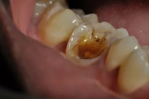 Cases of Restoration with Composite Resin - prestige-dental-