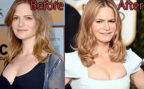 Jennifer Jason Leigh Surgery - designstructuralfab