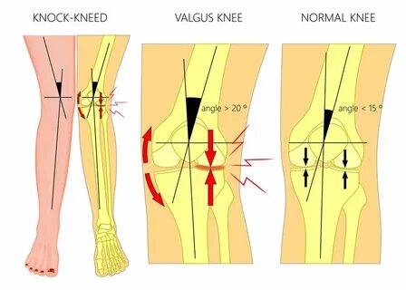 ARE "KNOCKED KNEES" A PROBLEM? - ACE Physical Therapy and Sp