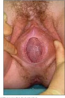 Septate hymen sex.