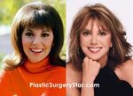 Star Plastic Surgery Before and After: Marlo Thomas Plastic 