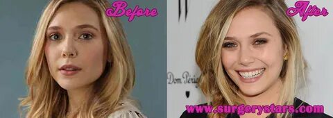 Elizabeth Olsen Nose Job Before & After Pictures