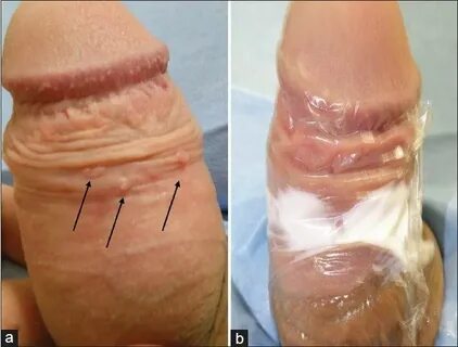 arrows, a) Multiple penile warts at the dorsal surface of th