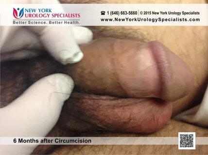Photo Gallery: Circumcised vs Uncircumcised - Adult Circumci