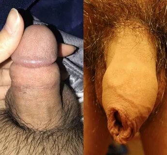 Swollen Foreskin On Uncircumcised Men Penis herbergdetramhal