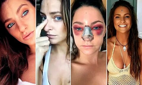 Meet the woman sharing her nose job 'journey' on social medi