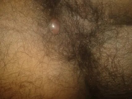painful and soft lump/bulge near my anus Haemorrhoids Forums