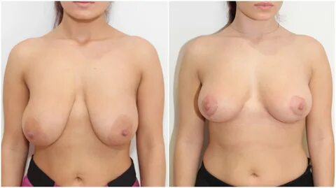 Boob reduction and lift