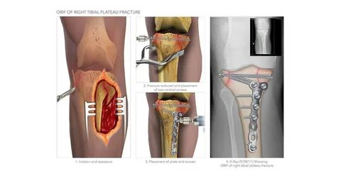 درمان جراحی در شکستگی پلاتوی تیبیا - وب سایت دکتر مهران سلیم