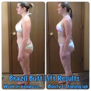 Brazil Butt Lift Results