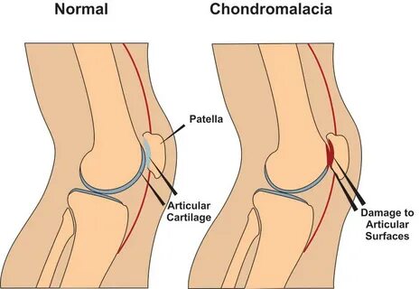 Chondromalacia Patellae Grad 2 - Captions Omega