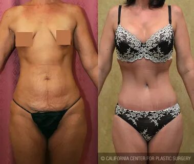Patient #5979 Body Contouring Before and After Photos Beverl