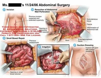 Abdomen After Hysterectomy Related Keywords & Suggestions - 