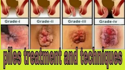 pilestreatment and techniques. facts and me in hindi - YouTu