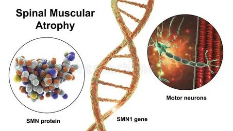 Spinal Muscular Atrophy, SMA, a Genetic Neuromuscular Disord