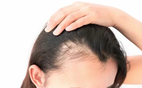 Female Pattern Hair Loss: A Comprehensive Guide - Dr. Viral 