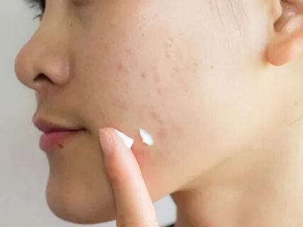 Best Home remedy to get rid of acne scars and pimple marks: 