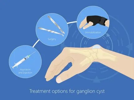 Ganglion Cyst Arizona Center for Hand to Shoulder Surgery