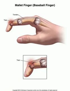 Hand Surgery Associates - Mallet Finger