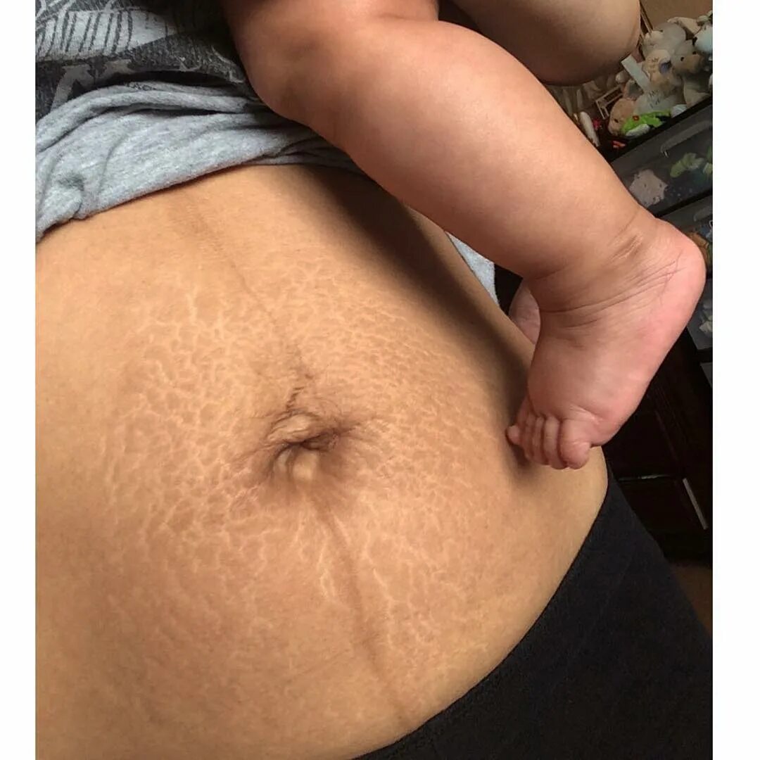 Yes, I have stretch marks. 