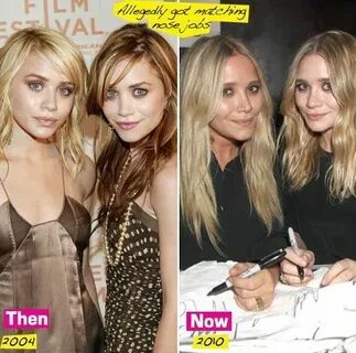 olsen twins plastic surgery picture Plastic Surgery Plastic 