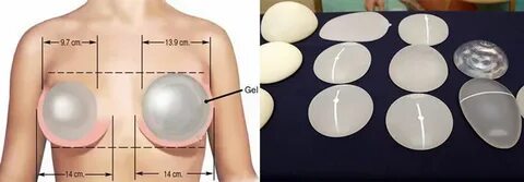 Сколько стоит увеличение грудных желез у высококвалифицирова