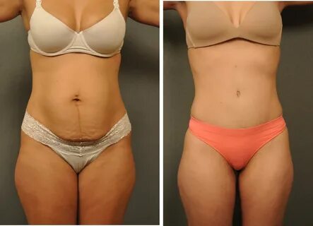 What is Tummy Tuck Drains and how it works? - TPS
