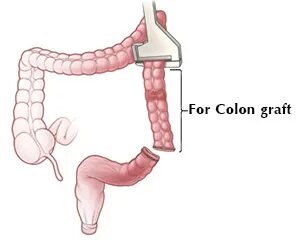 Colon graft technique (sigmoid colon vaginoplasty) Dr.Chetta