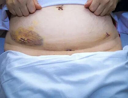 Best Appendicitis Scar Stock Photos, Pictures & Royalty-Free