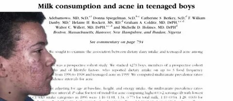 Does Milk Cause Acne : Does milk cause acne ? Check the answ