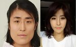 Korean Woman Gets New Face and a Fiancé Thanks To Amazing Pl