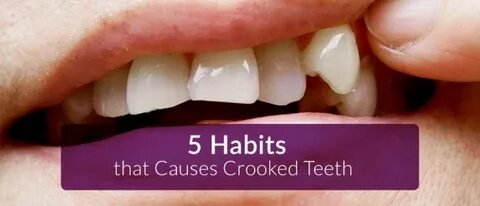 5 Habits That Cause Crooked Teeth - CARDS DENTAL