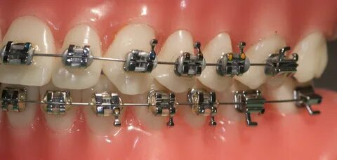 Ortho- braces, ceramic, self-ligating, elastics Teeth braces