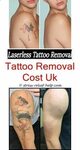 U Tattoo Removal - My Tattoo