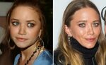 Elizabeth Olsen Plastic Surgery - With Before And After Phot