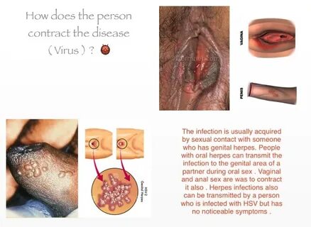 Oral sex and genital herpes