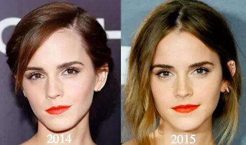 emma-watson-2014-2015 - Latest Plastic Surgery Gossip And Ne