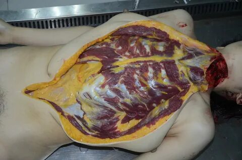 Autopsy of a beautiful Chinese girl whose throat cut - herde