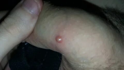 About A Pimple On The Penis