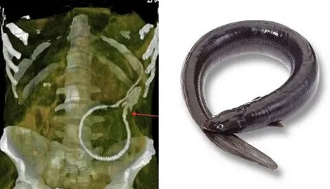 Man stuns medics with live eel stuck up his bum :: Zim Metro