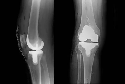 Mako Total Knee Replacement - Orthopaedic Associates of Musk